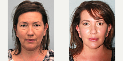 49 year old woman treated with Lifestyle Lift - This 49-year-old woman felt she looked older than her age. Unhappy with her jowls and neck.Notice after surgery how youthful she looks and the improved contour along her jaw and neckline. After photos were taken 1-year post-surgery and during that time she did add filler to her cheeks.