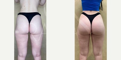 Woman treated with Butt Implants - Woman treated with Butt Implants