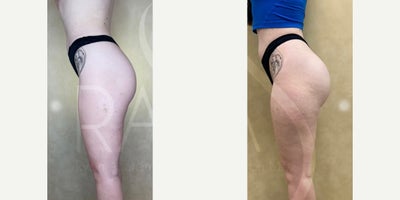Woman treated with Butt Implants - Woman treated with Butt Implants