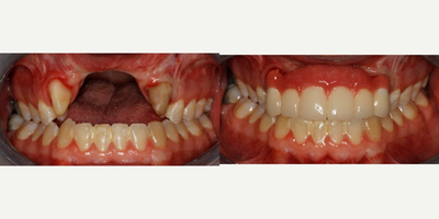 18-24 year old man treated with dental bridge to restore significant defect - When you have significant hard and soft tissue defect, the defect can be masked with porcelain. Special attention is needed on design for proper home care.