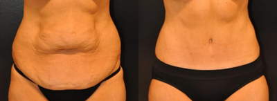 Woman treated with Tummy Tuck - Woman treated with Tummy Tuck