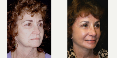 55-64 year old woman treated with Deep Plane Facelift, Facial Fat Transfer, Laser Resurfacing, Rhinoplasty, Lip Repositioning - This patient had total facial rejuvenation .