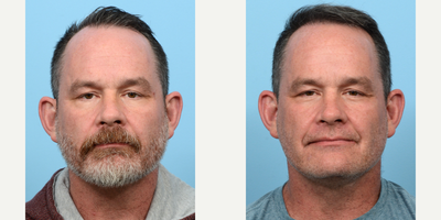 45-54 year old man treated with FUE Hair Transplant, Hair Transplant, Hair Loss Treatment, PRP for Hair Loss, PRP Injections - To fill in his hairline and add density, this patient underwent an FUE hair transplant and PRP therapy with Dr. Wise. During the procedure, 3,030 grafts were transplanted to zones 1 and 4 of the patient's scalp. His results are shown 6 months post-procedure.