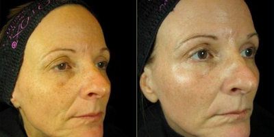 Woman treated with Pearl Laser - Pearl Laser