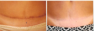 Fraxel  - Fraxel Abdomen