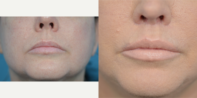 45-54 year old woman treated with Lip Lift - 54 year old patient concerned with the downward slant of the corners of her mouth.  A lip lift was performed to restore a more youthful appearance to her lips.