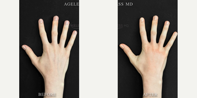 25-34 year old woman treated with Renuva - 3ML Renuva for the Hands