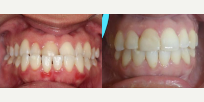 Woman treated with Braces - Meet our patient who started her braces/orthognathic surgery journey just a few months before we shut down due to coronavirus and still finished with this result in just 16 month!! Our patient had started with an underbite due to her lower jaw growing more forward than her upper jaw. She also had an asymmetry to her lower jaw which caused the center line of her face to shift to her right side.
