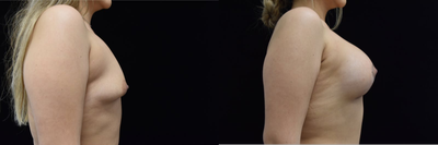 25-34 year old woman treated with Breast Augmentation - 28 yrs old womanCorrection of Tuberous Breast and augmentation450cc High Profile on the left and 385cc High profile on the rightIn these photos she is 1 month post-op