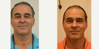 45-54 year old man treated with Facelift - This man is post op face lift. Pay attention to the neck, marionette and the nasolabial folds. He is very happy and doing well. We augmented this with some fat transfer (to give that more heart shape). He also had his upper eyelids treated.