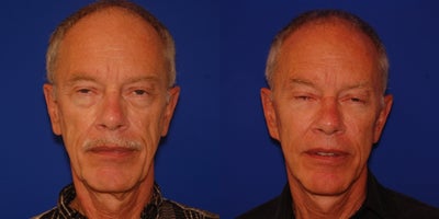 65-74 year old man treated with Lifestyle Lift - Facelift with natural appearance enhanced with fat graft to tear trough, cheeks and midface.