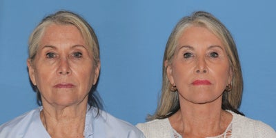 Woman treated with Deep Plane Facelift - Woman treated with Deep Plane Facelift