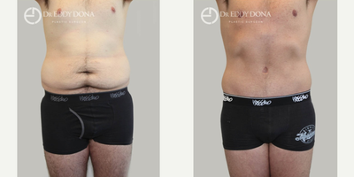 18-24 year old man treated with Male Abdominoplasty - Height 185cms, Weight 92kgs, Maximum weight 125kgs 18 months prior to surgery.