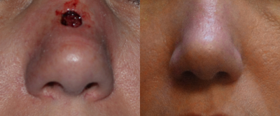 Woman treated after Mohs surgery - Woman treated after Mohs surgery with Mohs revision, 14 weeks postoperative, with adjunctive laser treatment.