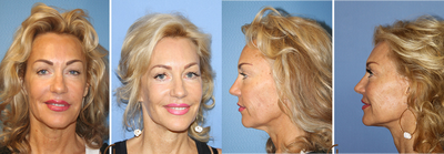Lower FaceLift & Neck Lift Under Local Anesthesia (No General Anesthesia Needed) - At almost 60 years old this active patient was looking to refresh her look. &nbsp;She felt that she was starting to look tired and her once defined jaw line was now showing nothing but excess skin laxity when she looked in the mirror. &nbsp;Dr. Kevin Sadati was able to performed a Natural Facelift, a lower facelift and neck lift done in office using local anesthesia and oral sedation. &nbsp;