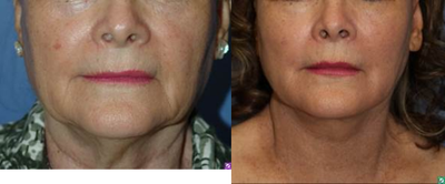 face and neck lift, 60 year old - This 60 patient comes to see us because she is not happy with her neck and jowls.&nbsp;