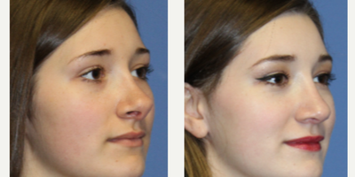 18-24 year old woman treated with Revision Rhinoplasty - Close up view of revision rhinoplasty