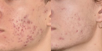 18-24 year old man treated with SkinPen - Combination of SkinPen Microneedling and Tretinoin