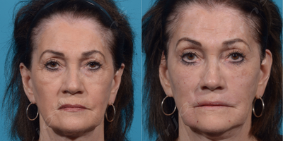 65-74 year old woman treated with Voluma - Liquid facelift:Botox: glabella, forehead, crows feetMidface: VolumaNasolabial folds/Marionette lines: VollureLip Lines: VolbellaSkin Resurfacing: Microneedling with PRP and AquaGold microbotox