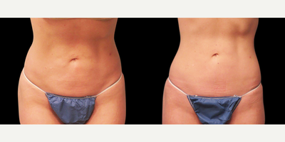 Emsculpt - Photo provided courtesy of BTL Industries, Inc., performed by Brian Kinney