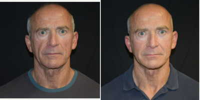 Man treated with Juvederm Voluma - Man treated with Juvederm Voluma