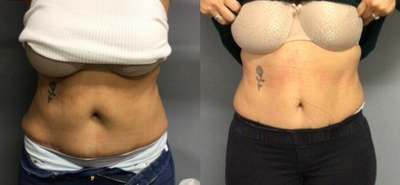 35-44 year old woman treated with Cryoskin - Patient after 5 cryoslimming sessions on abdomen and 2 cryoslimming sessions on back (handles)