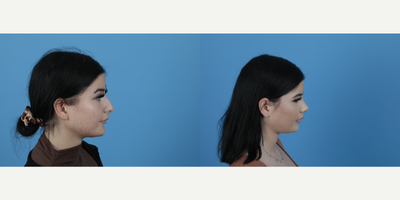 18-24 year old woman treated with Rhinoplasty - Even if it's 10 days the change looks so great