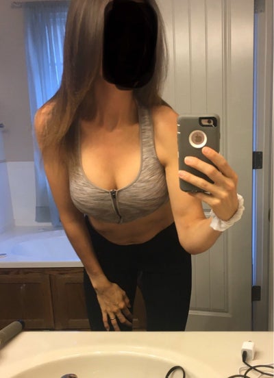 5'10” 36aaa or 34aa getting 295 moderate plus xtra - Review - RealSelf