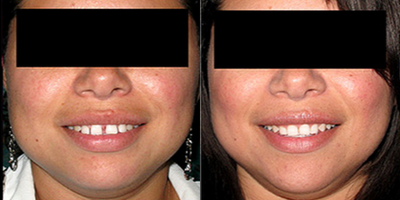 Invisalign - Invisalign