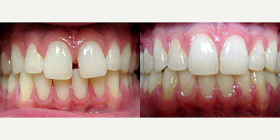 Invisalign - Invisalign