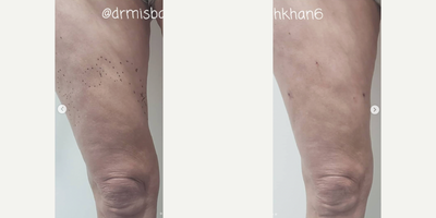 Woman treated with Liposuction Revision - Revision Surgery for thigh defects. This is an interesting case. The patient had a lot of defects. The challenge here is that she is skinny and each defect gets magnified 10x on a smaller skinnier individual. I was able to fix most of them.