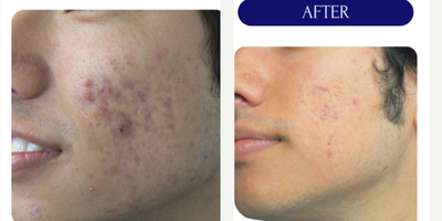 17 or under year old man treated with LaserACNE TREATMENT - LASER ACNE TREATMENT