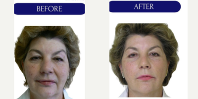 55-64 year old woman treated with Thread Lift, MINT threadlift - mint threadlift