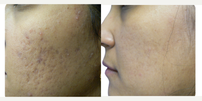 35-44 year old woman treated with Laser Resurfacing, CO2 Laser, YAG Laser, Fractional Laser, UltraPulse CO2 Laser, Facial - LASER ACNE TREATMENT