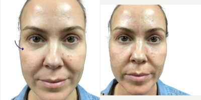 45-54 year old woman treated with Aquagold, Facial - REVIVIFY TREATMENT USING AQUAGOLD FINE TOUCH