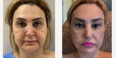 55-64 year old woman treated with Neck Lift, Brow Lift, Eyelid Surgery, Lip Lift - 55-64 year old woman treated with Neck Lift, Brow Lift, Eyelid Surgery, Lip Lift