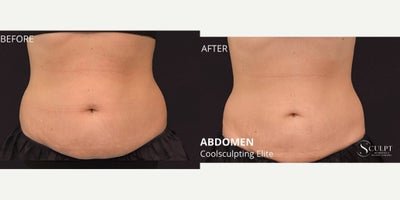 25-34 year old woman treated with CoolSculpting Elite - Before & After CoolSculpting Flanks