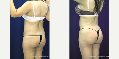 35-44 year old woman treated with Brazilian Butt Lift - Total amount of fat removed: 4500 ccTotal amount of fat injected: 1200 cc