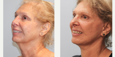 65-74 year old woman treated with Chin Liposuction - This woman in her late 60s wished to improve the excess loose tissue in her neck area with an emphasis on a natural appearance. She and Dr. Howell decided a facelift with submental liposuction would be her best option. She is extremely happy with her results and feels her scars are well hidden. She is pictured before and three months after surgery