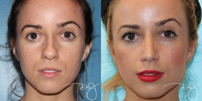Rhinoplasty - Open rhinoplasty
