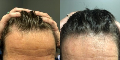 65-74 year old woman treated with Low-Level Laser Therapy - 3 PRP Hair Restoration, 1 month apart combined with Low Level Laser Therapy