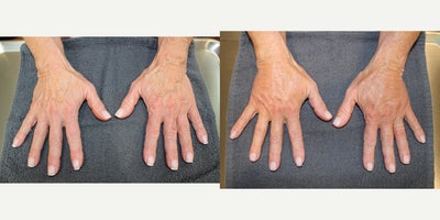 65-74 year old woman treated with ALMI - ALMI hands: 67 y/o F, G2P2, 50, 113 lbs,