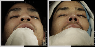 25-34 year old man treated with Asian Rhinoplasty - 25-34 year old man treated with Asian Rhinoplasty