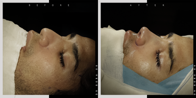 25-34 year old man treated with Asian Rhinoplasty - 25-34 year old man treated with Asian Rhinoplasty