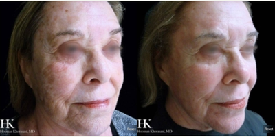 Woman treated with TotalFX - Woman treated with TotalFX