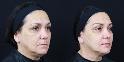 55 year old female treated with fillers (Sculptra Aesthetic, Restylane Defyne) and Thermage FLX - Dr. Patel treated this 55 year old female with Sculptra in the midface/cheeks and Restylane Defyne into her laugh lines. She also had nonsurgical skin tightening with the Thermage FLX to her face and jawline.