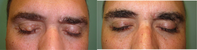  Bilateral upper and lower lid cysts. - 	Excision of upper and lower lid cysts