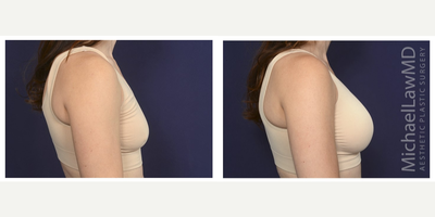 35-44 year old woman treated with Ideal Implant - Breast augmentation. Follow-up photo taken 3 months after the procedure.