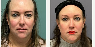 45-54 year old woman treated with Forehead Reduction, Brow Lift, Revision Rhinoplasty, Septoplasty, Lip Surgery - This young woman underwent forehead feminization, septorhinoplasty, lip surgery and augmentation.