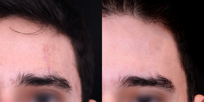 18-24 year old male treated with excision followed by scar resurfacing with fractional CO2 laser and dermabrasion - A 25-34 year old male who underwent excision to remove a traumatic scar followed by scar resurfacing with fractional CO2 laser and dermabrasion
